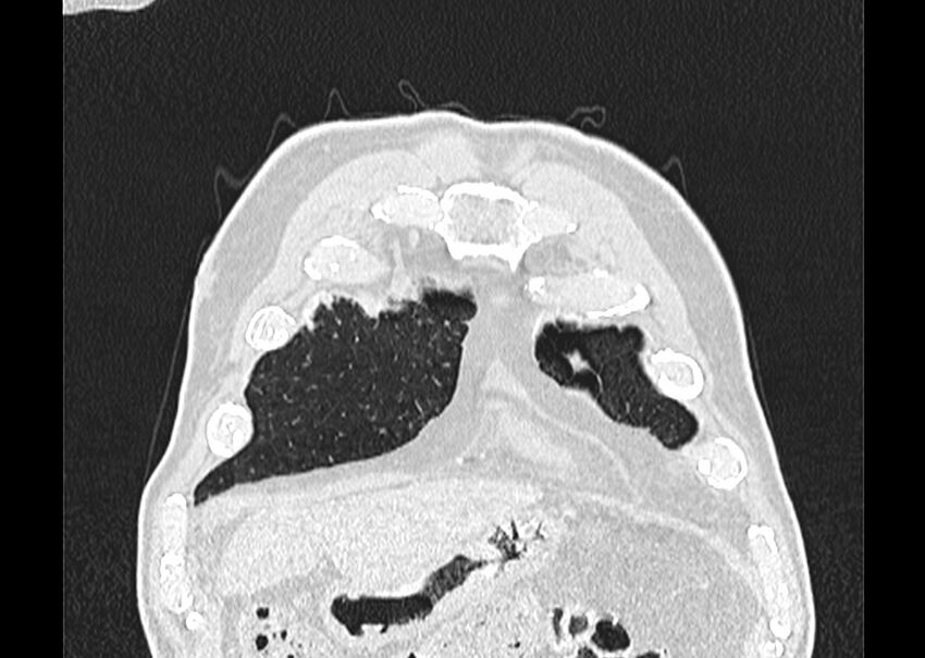 Asbestos pleural placques (Radiopaedia 57905-64872 Coronal lung window 20).jpg