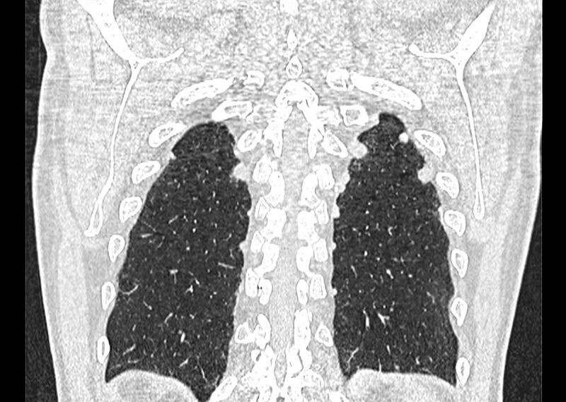File:Asbestos pleural placques (Radiopaedia 57905-64872 Coronal lung window 251).jpg