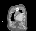 Ascending aortic aneurysm (Radiopaedia 86279-102297 B 2).jpg
