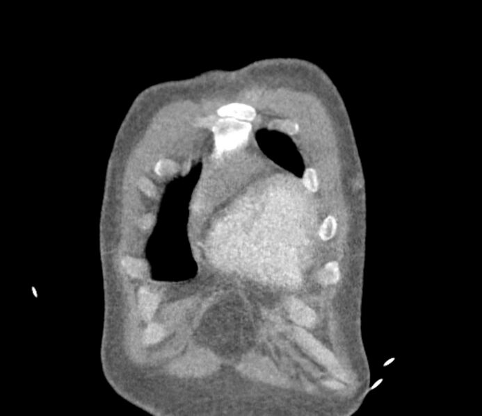 File:Ascending aortic aneurysm (Radiopaedia 86279-102297 B 2).jpg