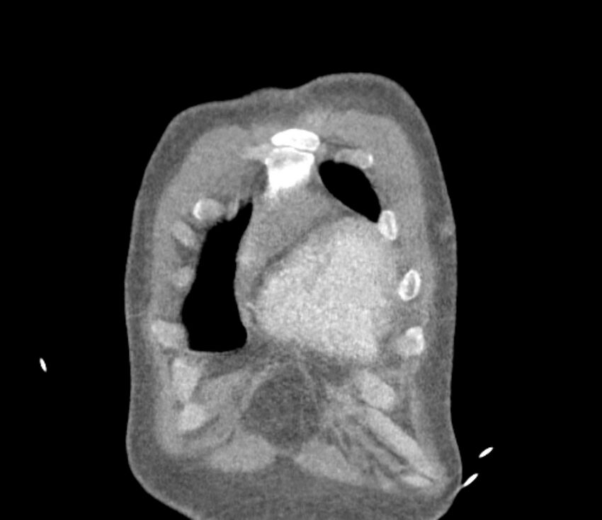 Ascending aortic aneurysm (Radiopaedia 86279-102297 B 2).jpg