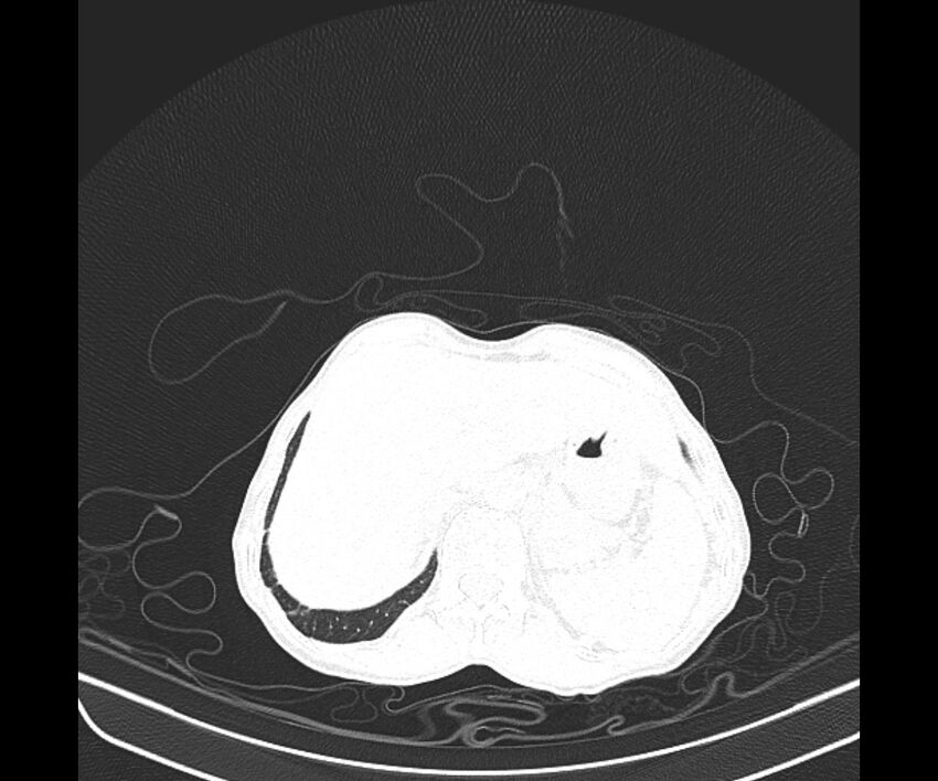 Aspergillomas (Radiopaedia 66779-76110 Axial lung window 46).jpg