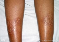 Asteatotic dermatitis