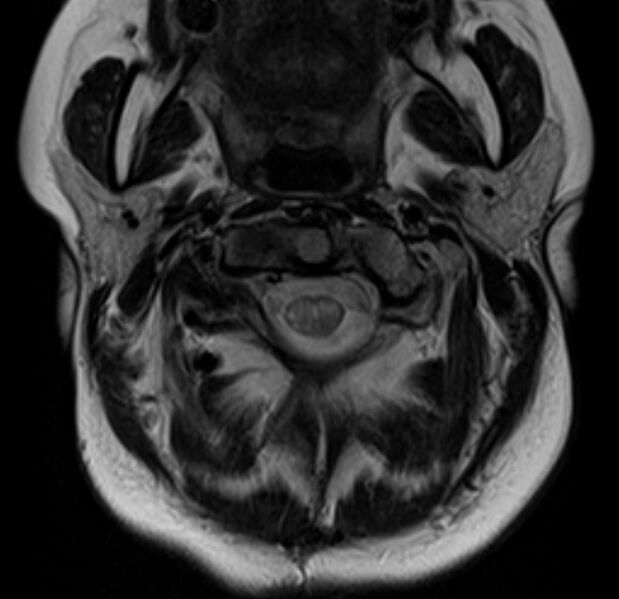 File:Astrocytoma - spinal cord (Radiopaedia 69769-79758 Axial T2 5).jpg