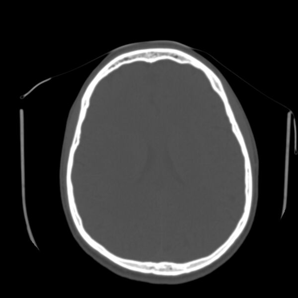 File:Asymptomatic occipital spur (Radiopaedia 87753-104201 Axial bone window 125).jpg