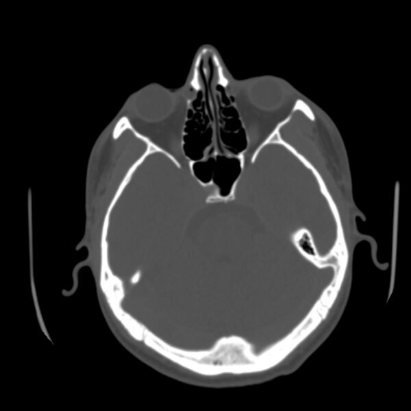 File:Asymptomatic occipital spur (Radiopaedia 87753-104201 Axial bone window 54).jpg