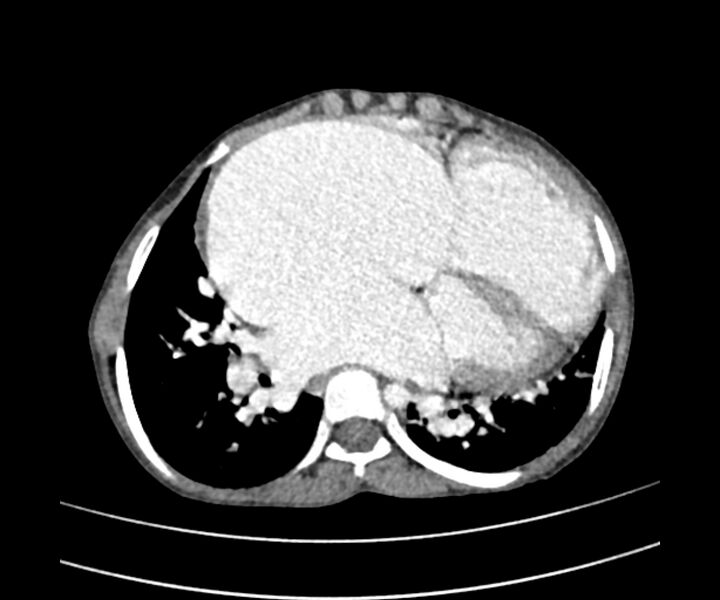 File:Atrial septal defect complicated by Eisenmenger syndrome (Radiopaedia 53707-59768 Axial C+ CTPA 20).jpg