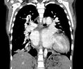 Atrial septal defect complicated by Eisenmenger syndrome (Radiopaedia 53707-59768 Coronal C+ CTPA 14).jpg