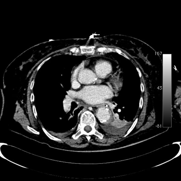 File:Atypical dissection of the thoracic aorta (Radiopaedia 10975-78320 A 37).jpg