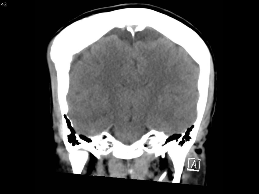 Atypical meningioma - intraosseous (Radiopaedia 64915-73867 B 42).jpg