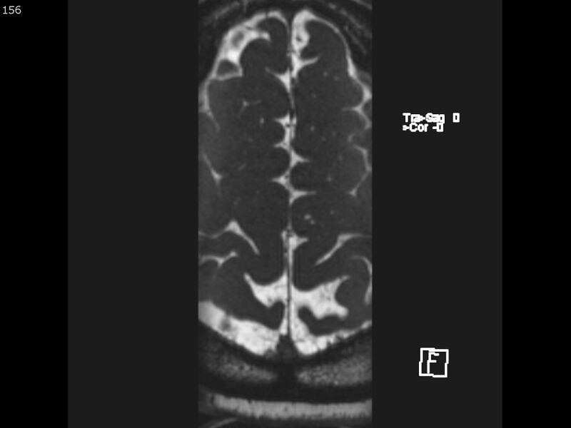 File:Atypical meningioma - intraosseous (Radiopaedia 64915-74572 Axial CISS 156).jpg
