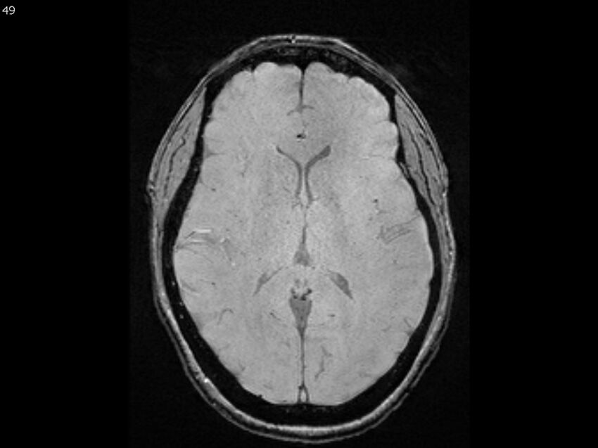 Atypical meningioma - intraosseous (Radiopaedia 64915-74572 Axial SWI 49).jpg
