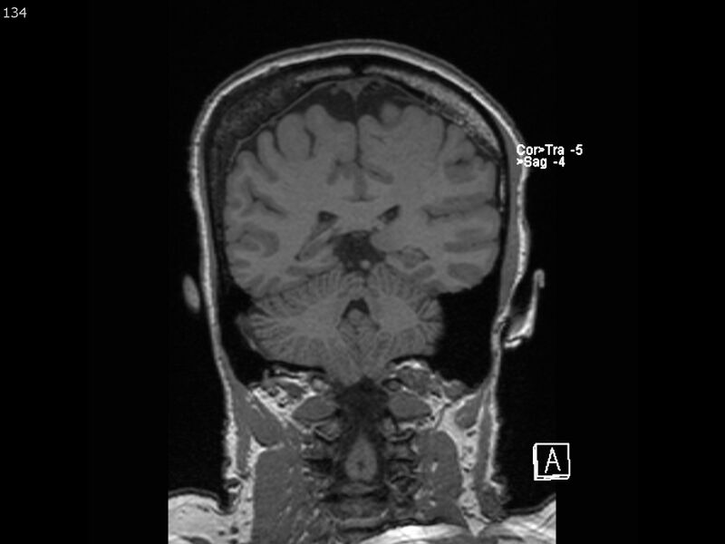File:Atypical meningioma - intraosseous (Radiopaedia 64915-74572 Coronal T1 134).jpg