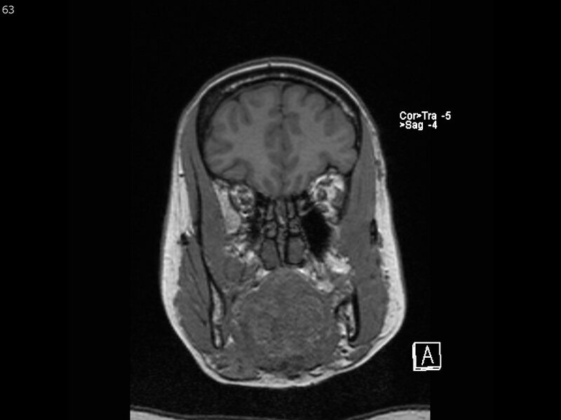 File:Atypical meningioma - intraosseous (Radiopaedia 64915-74572 Coronal T1 63).jpg