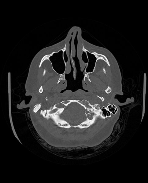 File:Automastoidectomy with labyrinthine fistula (Radiopaedia 84143-99411 Axial non-contrast 59).jpg