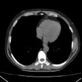 Autosomal dominant polycystic kidney disease (Radiopaedia 36539-38101 Axial non-contrast 2).jpg