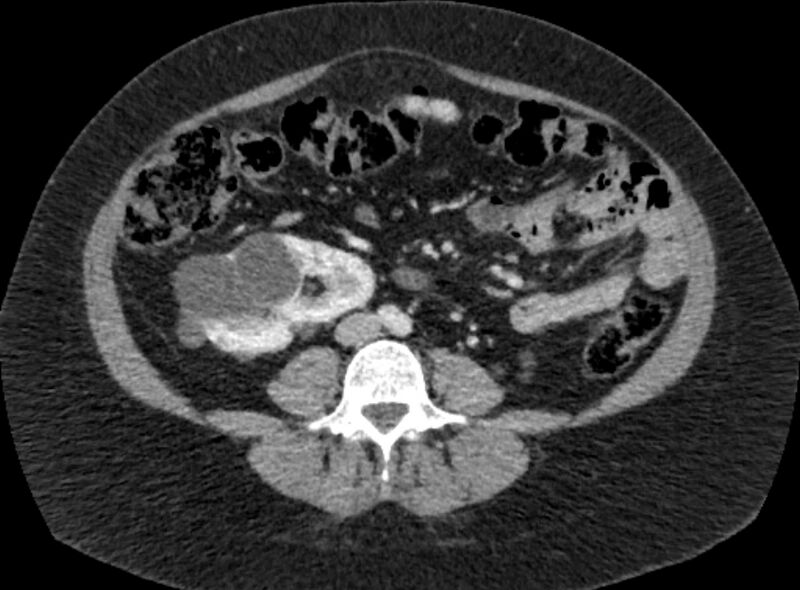 File:Autosomal dominant polycystic kidney disease (Radiopaedia 57124-64017 A 67).jpg