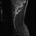 Axis fracture - MRI (Radiopaedia 71925-82375 Sagittal STIR 7).jpg