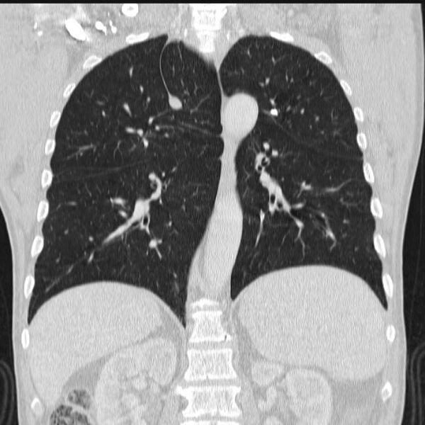 File:Azygos lobe (Radiopaedia 38259-40275 Coronal lung window 51).jpg
