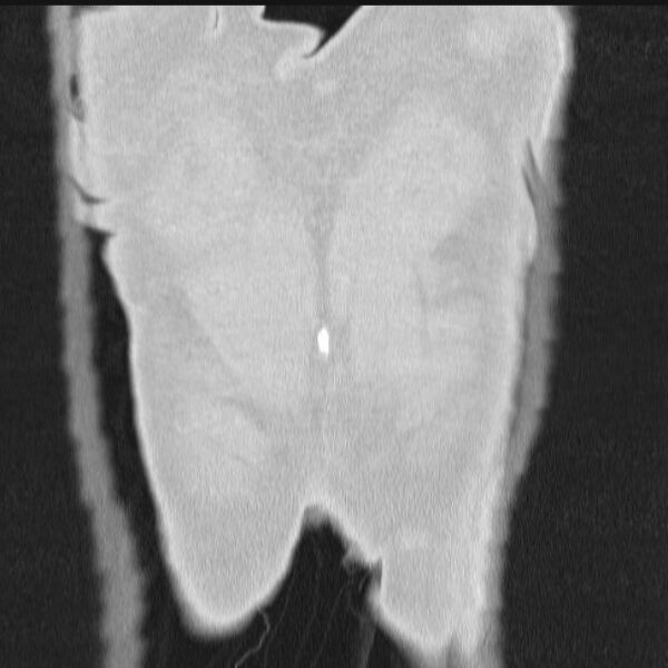 File:Azygos lobe (Radiopaedia 38259-40275 Coronal lung window 76).jpg