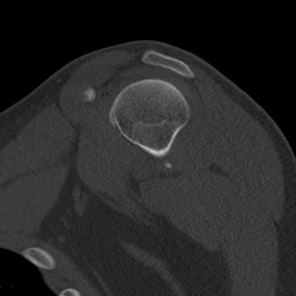 File:Bankart lesion (Radiopaedia 22771-22798 Sagittal bone window 19).jpg