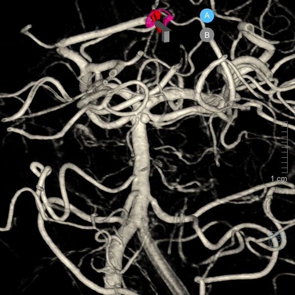 File:Basilar artery perforator aneurysm (Radiopaedia 82455-97734 3D view left VA 2).jpg
