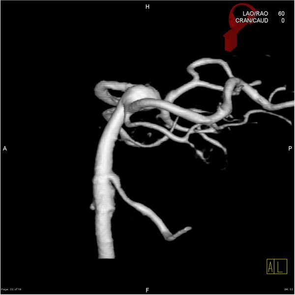 File:Basilar tip aneurysm double balloon remodeling (Radiopaedia 18100-17883 3D rotation 11).jpg