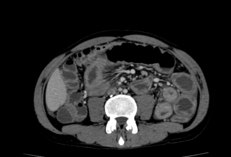 File:Behçet's disease- abdominal vasculitis (Radiopaedia 55955-62570 A 44).jpg