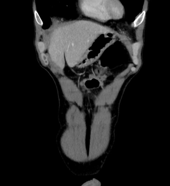 File:Behçet's disease- abdominal vasculitis (Radiopaedia 55955-62570 B 1).jpg