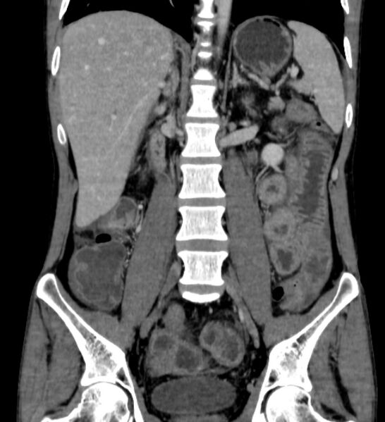 File:Behçet's disease- abdominal vasculitis (Radiopaedia 55955-62570 B 34).jpg