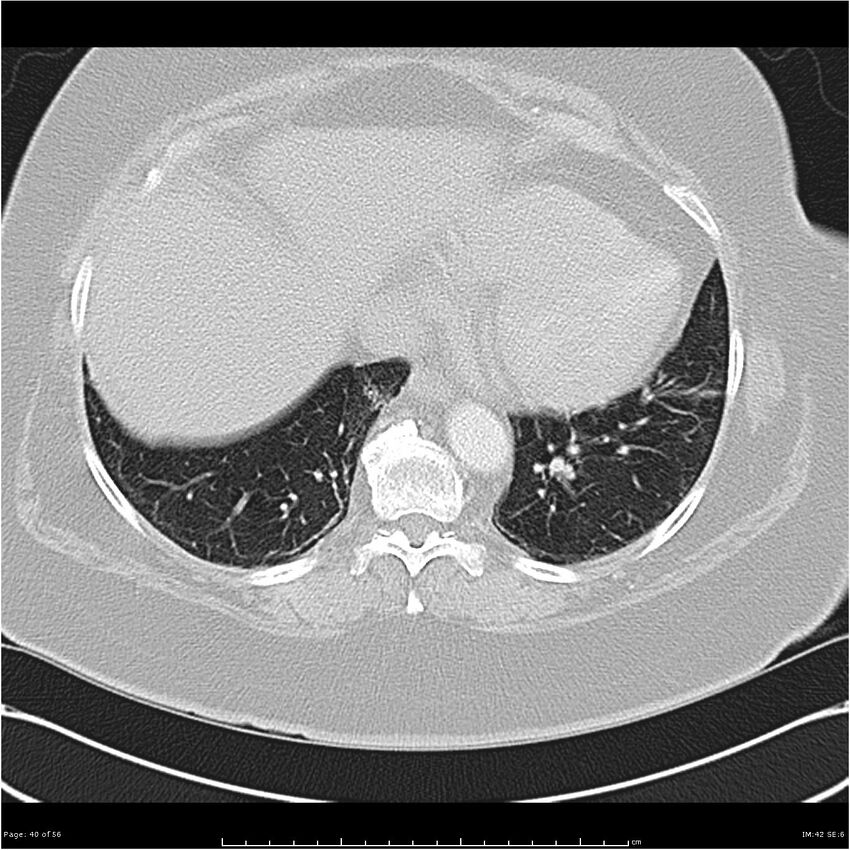 Benign metastasizing leiomyoma (Radiopaedia 26803-26962 Axial lung window 40).jpg