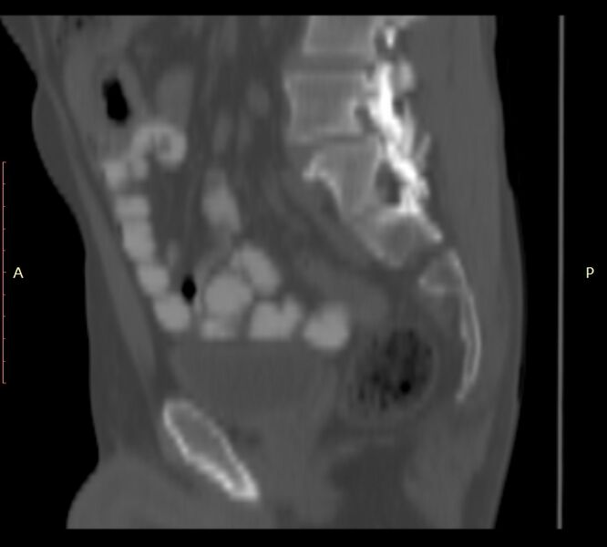 File:Bertolotti syndrome (Radiopaedia 58974-66235 Sagittal bone window 34).jpg