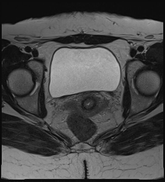 File:Bicornuate, unicollis uterus (Radiopaedia 79468-92593 Axial T2 16).jpg