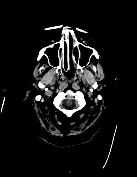 File:Bilateral acute middle cerebral artery territory infarcts (Radiopaedia 77319-89401 Axial non-contrast 1).jpg