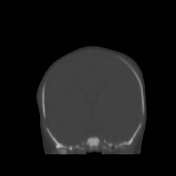File:Bilateral cephalohematomas and subdural hematomas (Radiopaedia 26778-26929 Coronal bone window 9).jpg