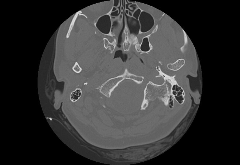 File:Bilateral otospongiosis (Radiopaedia 35447-36940 Axial bone window 1).jpg