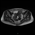 Bilateral ovarian fibroma (Radiopaedia 44568-48293 Axial T2 15).jpg