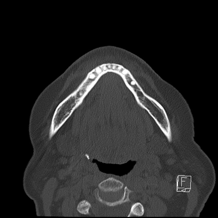 Bilateral palatine tonsilloliths on OPG and CT (Radiopaedia 75167-86247 Axial bone window 49).jpg