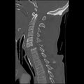Bilateral perched facets with cord injury (Radiopaedia 45587-49713 Sagittal bone window 26).jpg