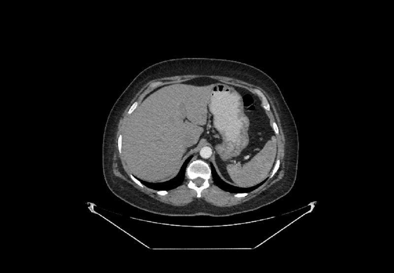 File:Bilateral urolithiasis with incidentally detected splenic artery aneurysm and left inferior vena cava (Radiopaedia 44467-48127 A 4).jpg