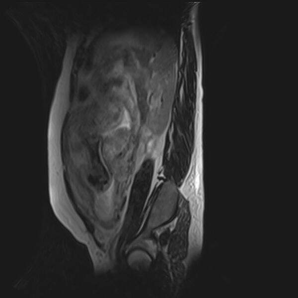 File:Bilobed placenta accreta (Radiopaedia 69648-79591 G 16).jpg