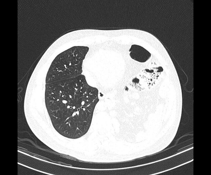 File:Bochdalek hernia - adult presentation (Radiopaedia 74897-85925 Axial lung window 32).jpg