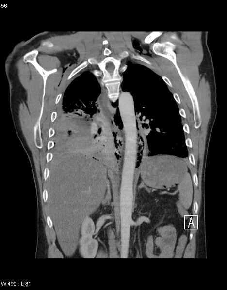 File:Boerhaave syndrome with tension pneumothorax (Radiopaedia 56794-63605 B 23).jpg