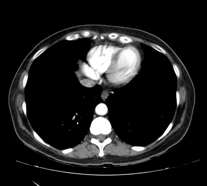 File:Bosniak renal cyst - type IV (Radiopaedia 22929-22953 B 3).jpg