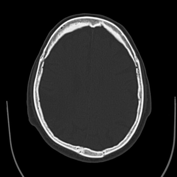 File:Brain Pantopaque remnants (Radiopaedia 78403-91048 Axial bone window 46).jpg