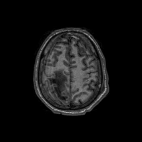 File:Brain abscess complicated by intraventricular rupture and ventriculitis (Radiopaedia 82434-96577 Axial T1 58).jpg