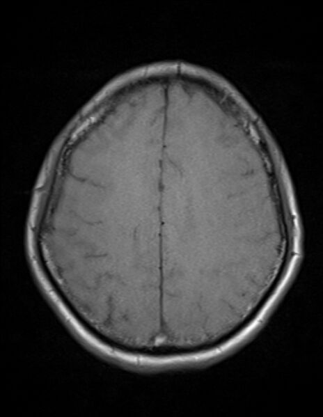 File:Brain abscess with ventriculitis (Radiopaedia 85703-101495 Axial T1 20).jpg