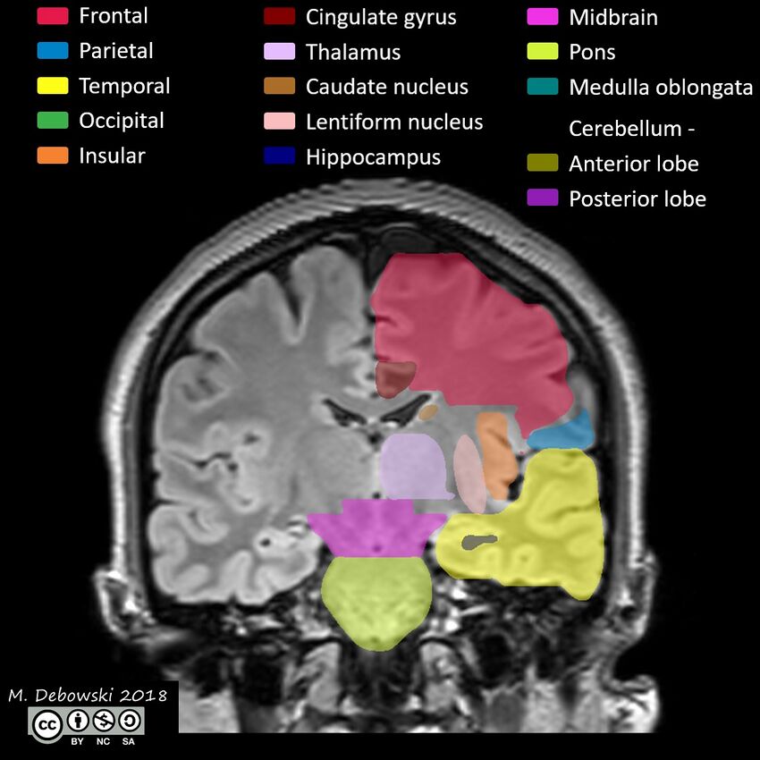 Brain lobes - annotated MRI (Radiopaedia 61691-69700 Coronal 37).JPG