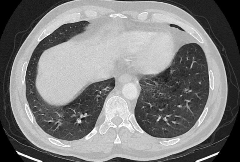 File:Brain metastases - lung cancer primary (Radiopaedia 75060-86116 Axial lung window 48).jpg