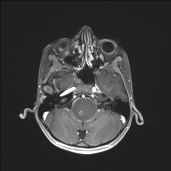 File:Brainstem glioma (Radiopaedia 70548-80674 Axial T1 C+ 40).jpg